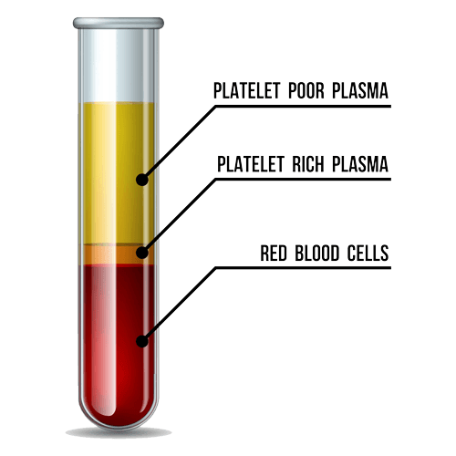 PRP (Platelet-Rich Plasma)