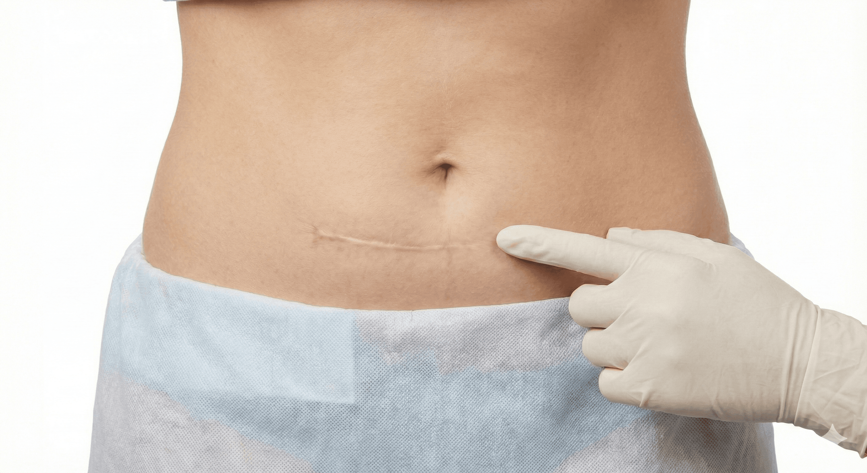 우아한 Labiaplasty 4S™